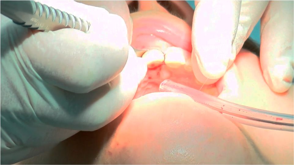 Exodoncia atraumática