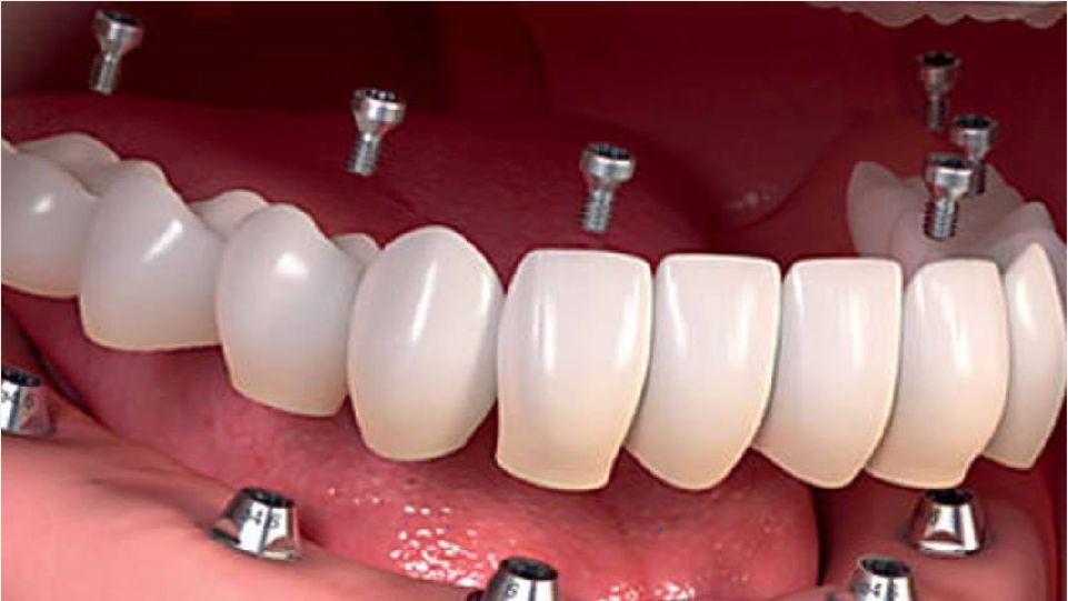Implantes dentales