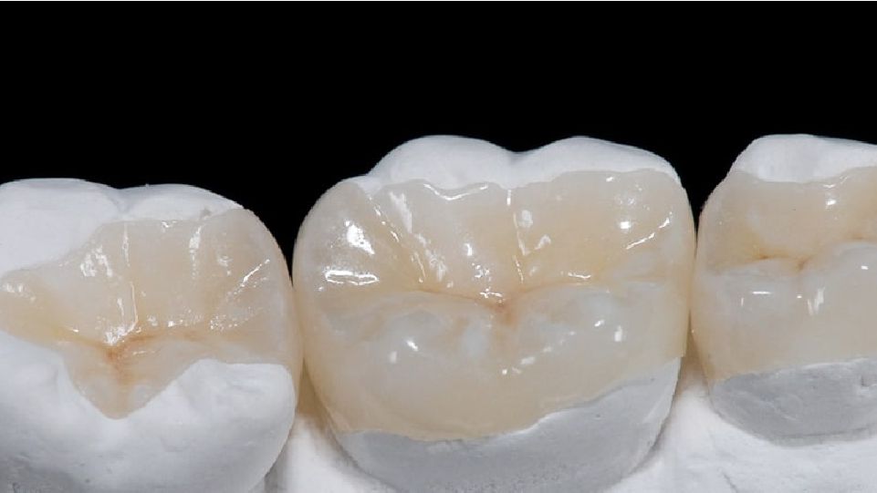 Incrustaciones Inlay / Onlay