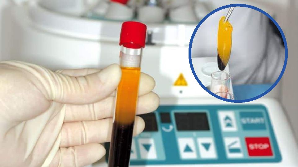 Fibrina rica en plaquetas