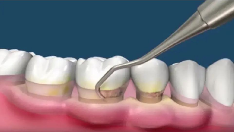 Raspaje y alisado radicular